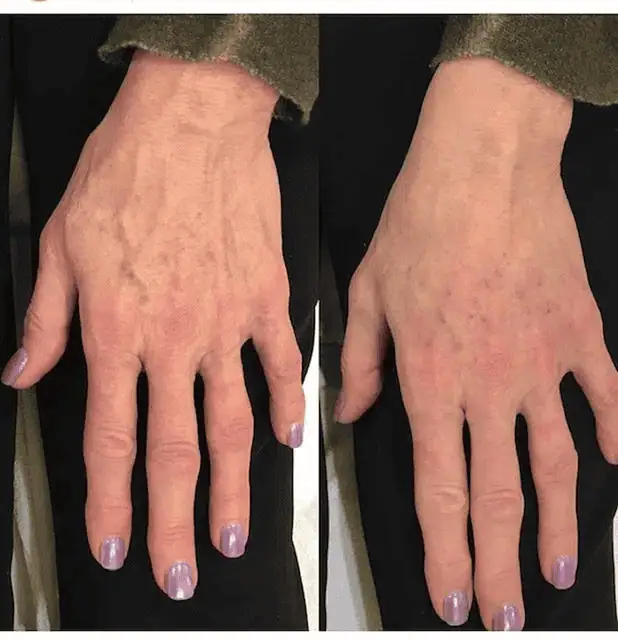 Body Fillers before and after results
