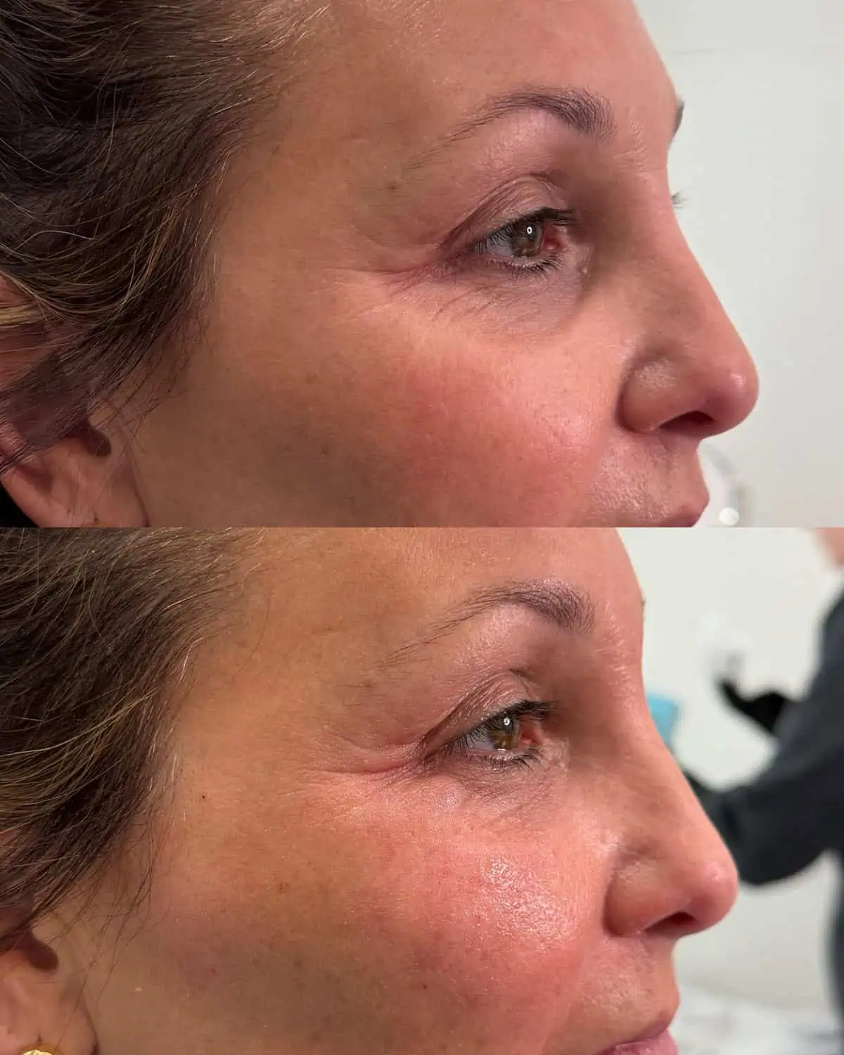 PRP/PRF Gel before and after results