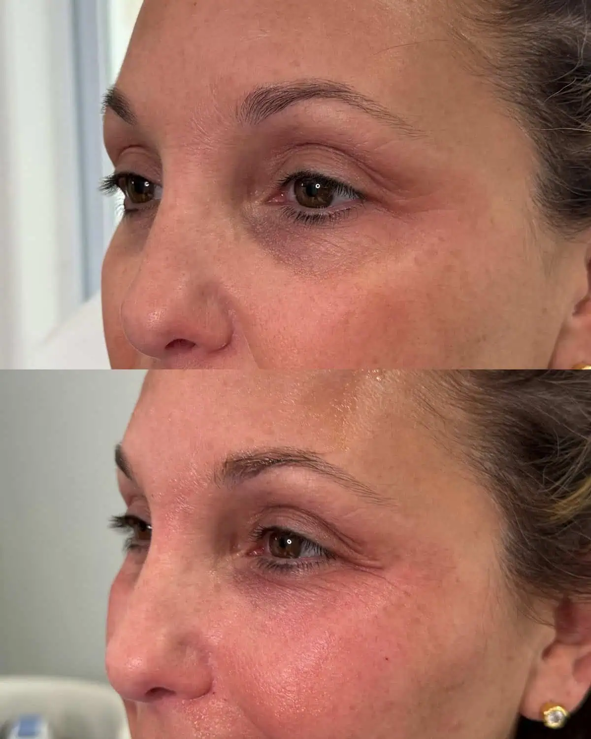 PRP/PRF Gel before and after results