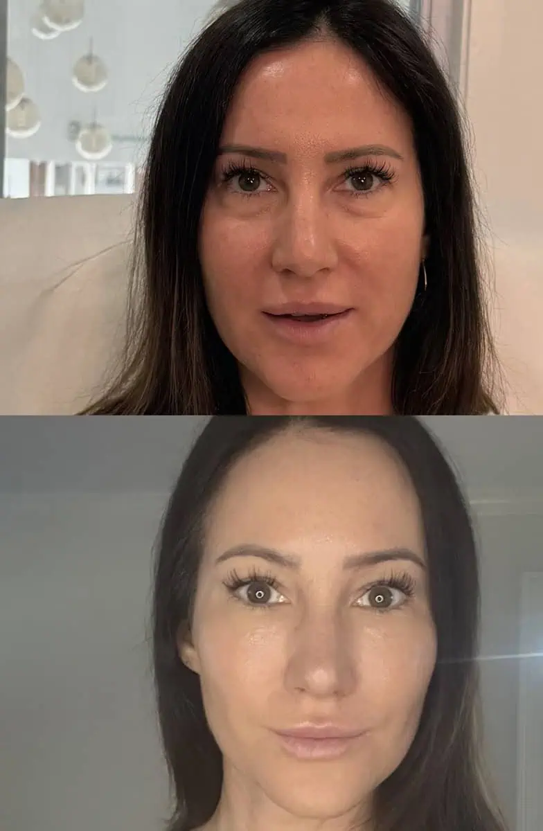 PRP/PRF Gel before and after results
