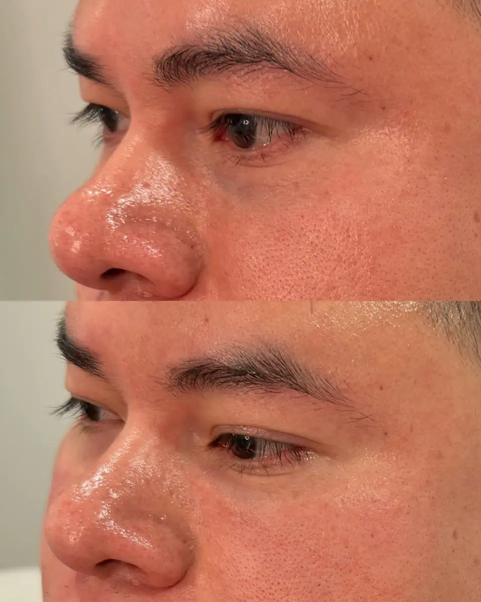 PRP/PRF Gel before and after results