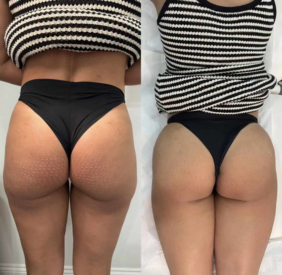 Body Fillers before and after results