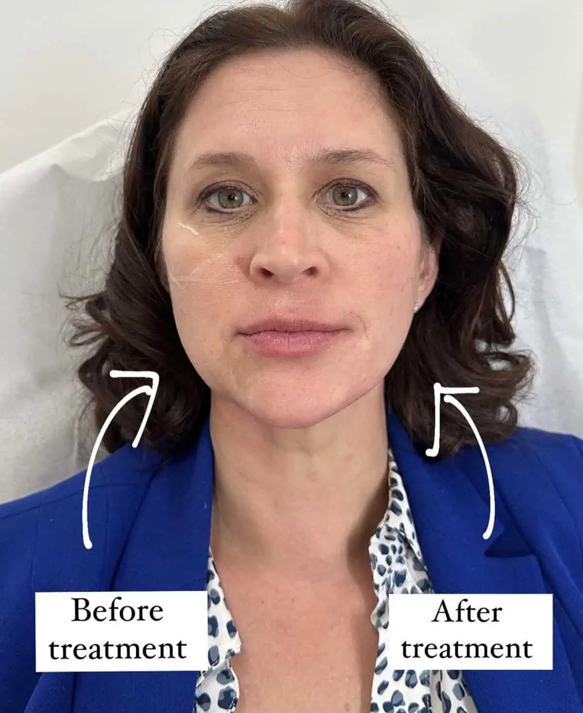 Facial Fillers before and after results