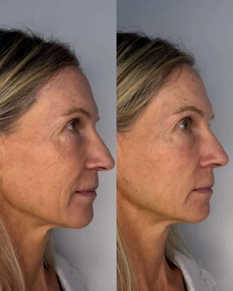 Sculptra before and after results