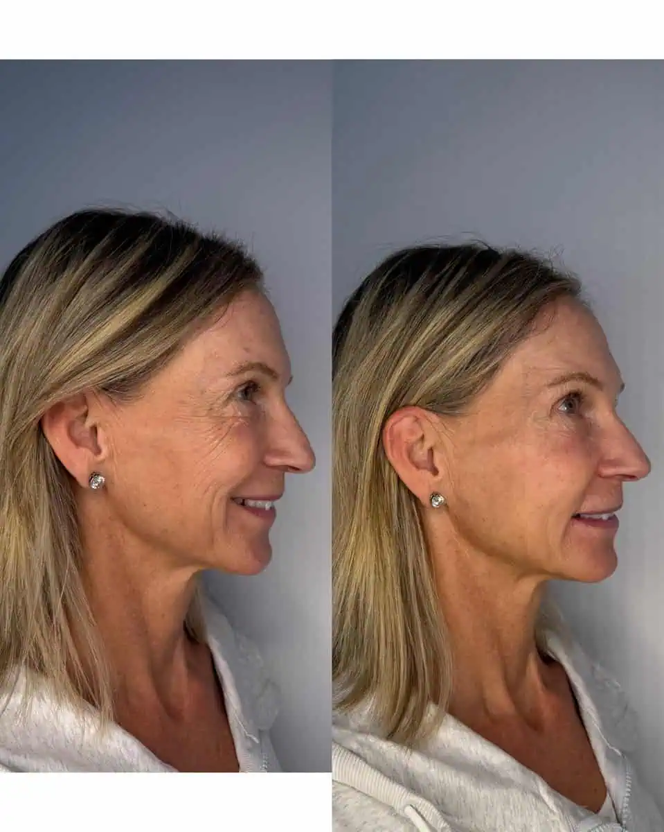 Sculptra before and after results