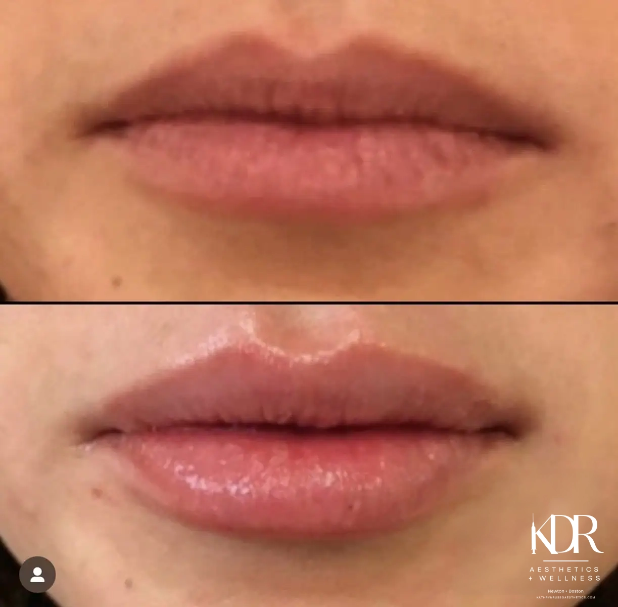 Facial Fillers before and after results