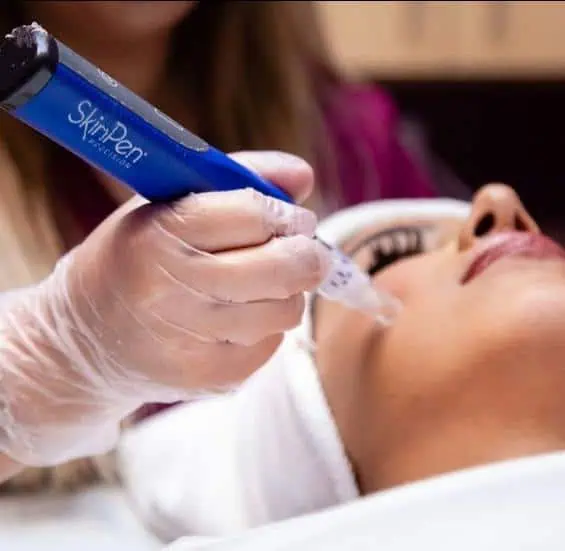 Laser and microneedling treatment in Boston, MA