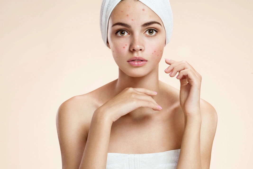Woman with a towel wrapped around her hair preparing for a skin treatment