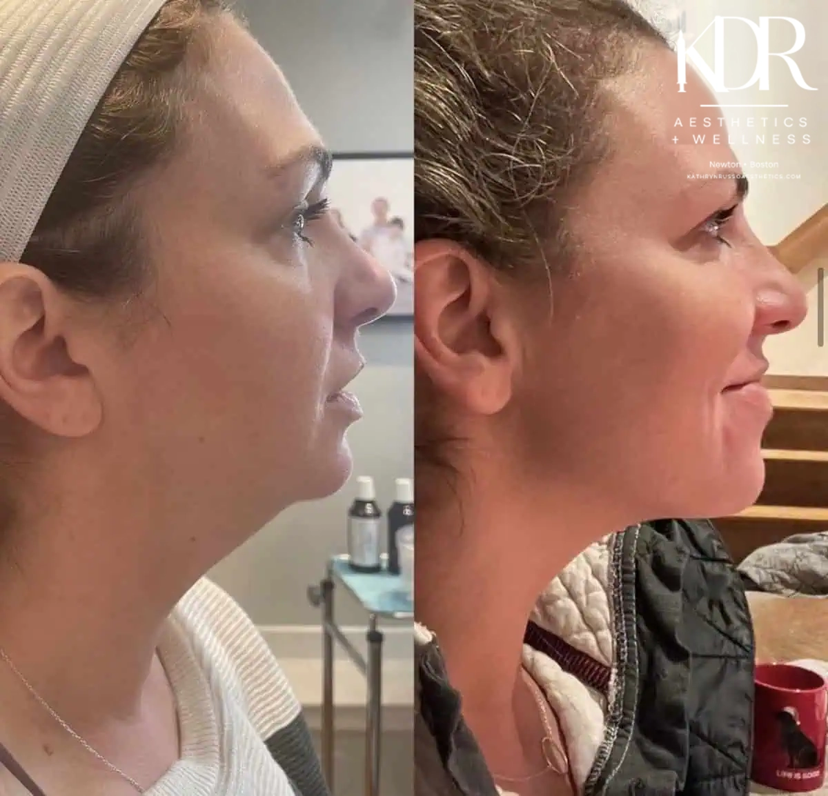 Kybella before and after results