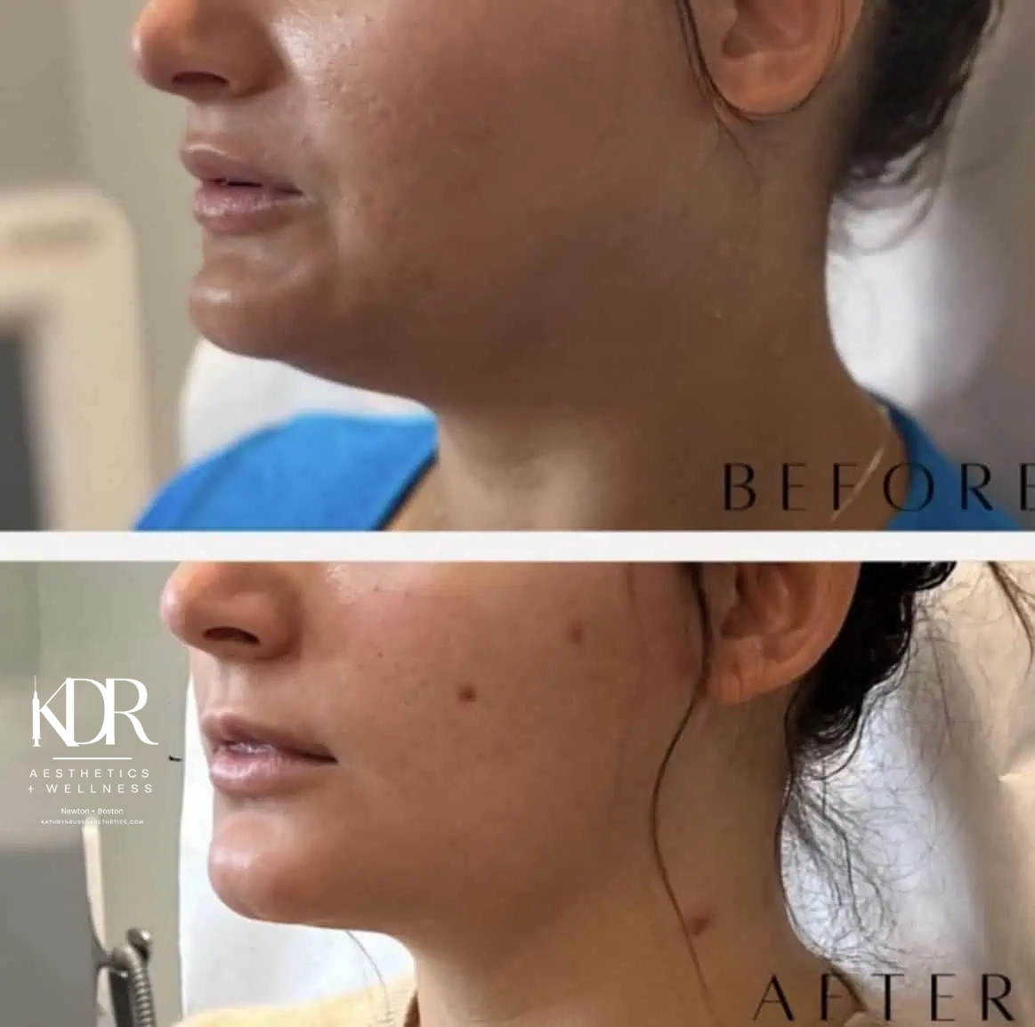 Kybella before and after results