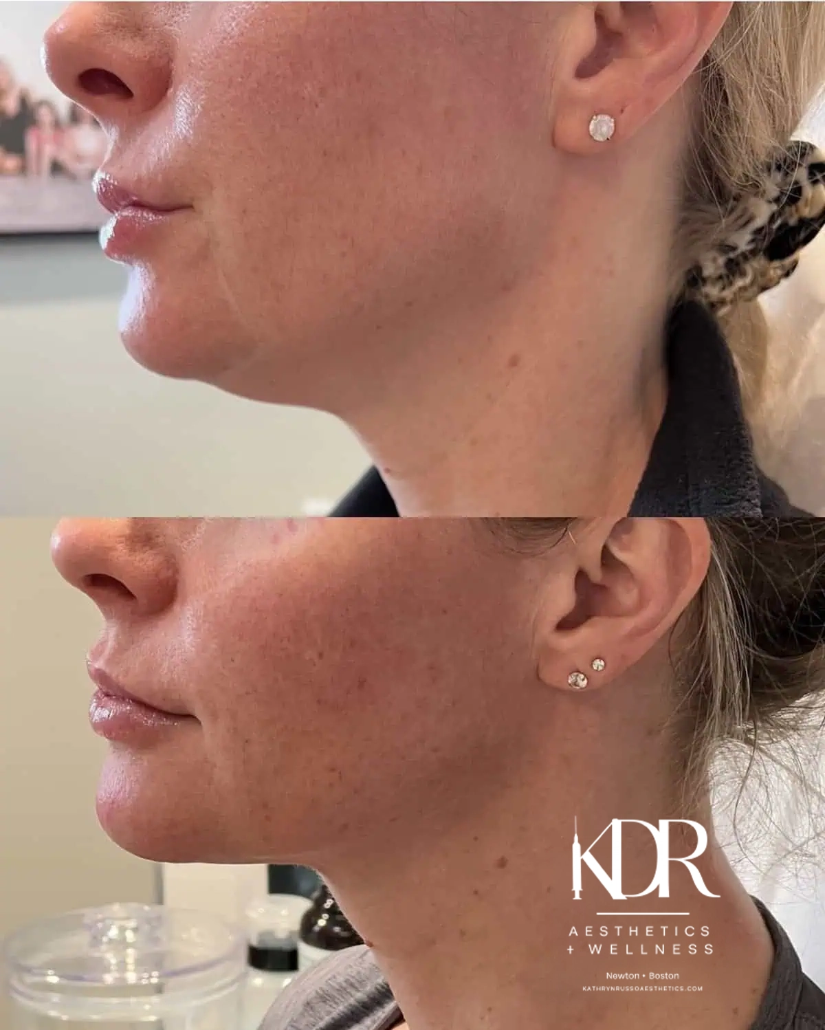 Kybella before and after results