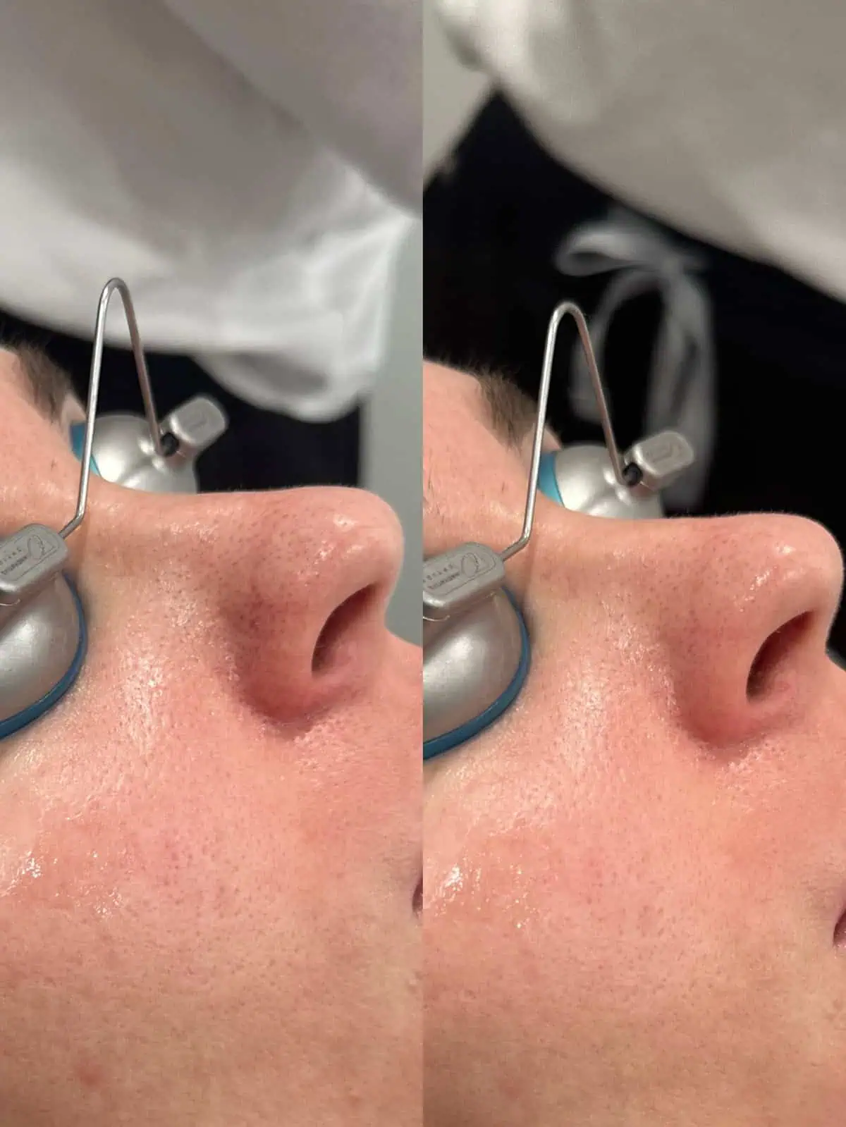 Facial Treatments before and after results