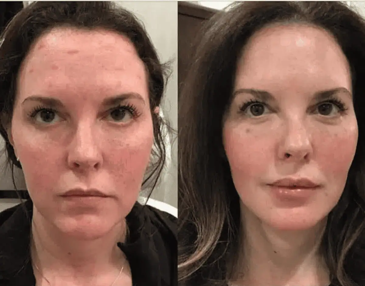 Facial Fillers before and after results