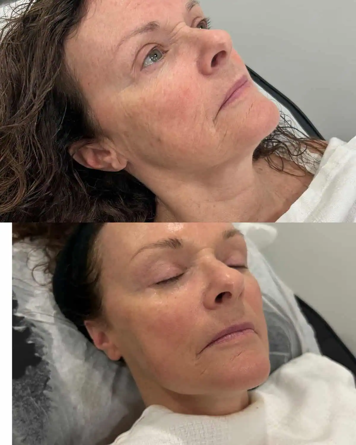 Facial Treatments before and after results
