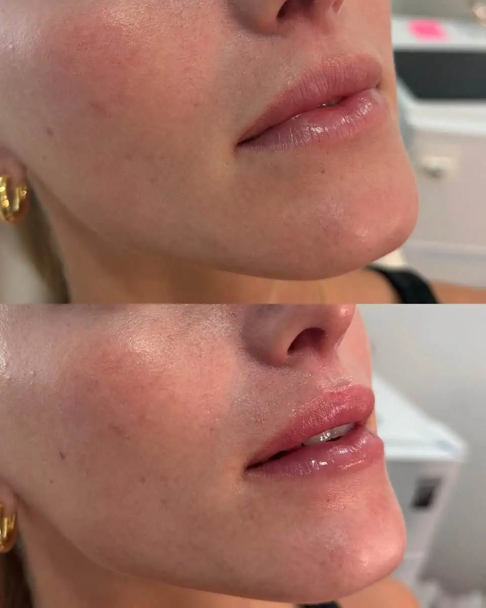 Facial Fillers before and after results