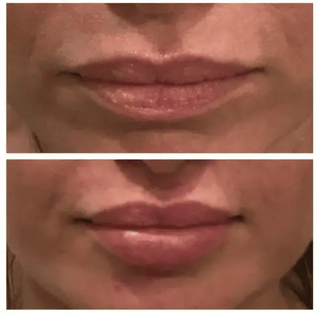 Facial Fillers before and after results