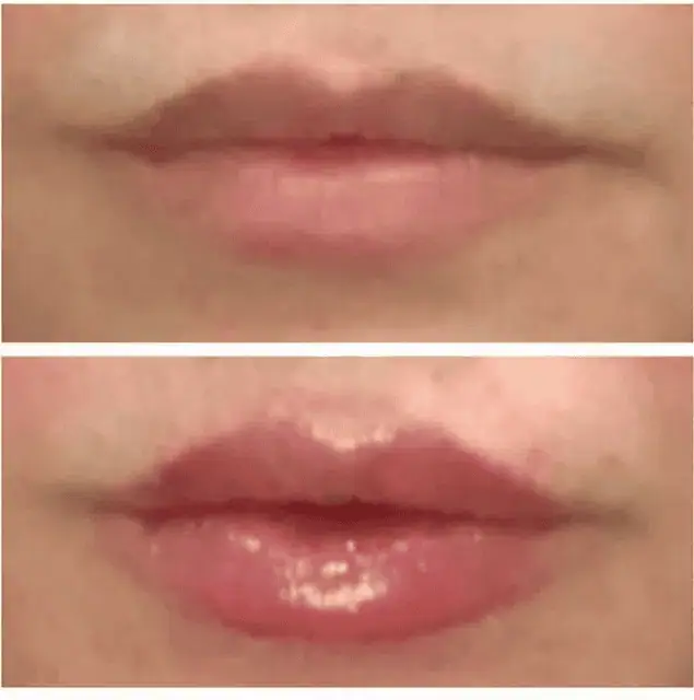 Facial Fillers before and after results