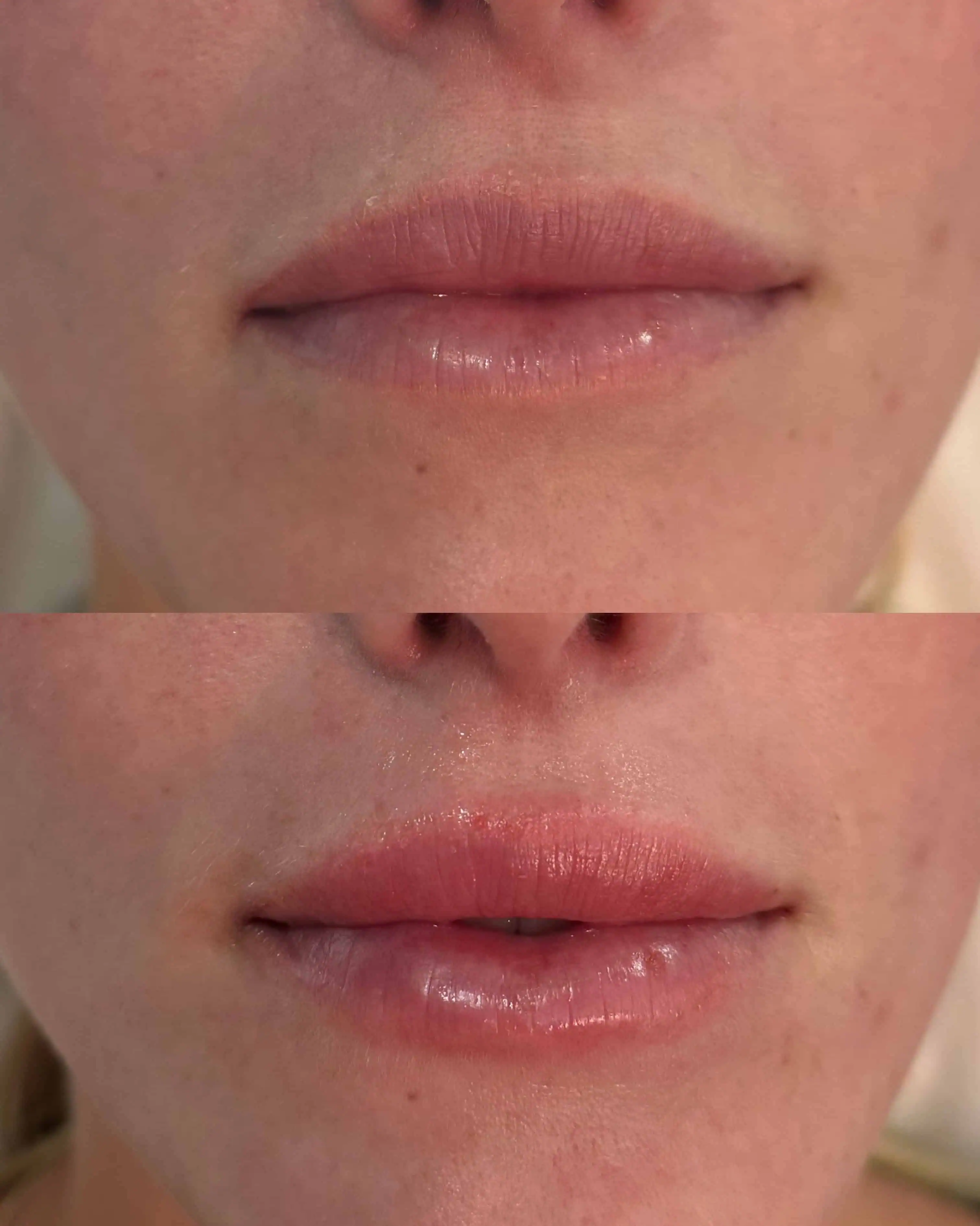 Facial Fillers before and after results