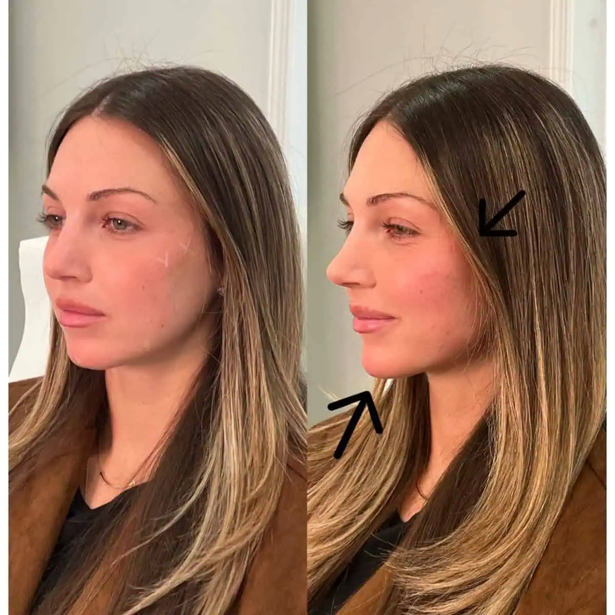 Facial Fillers before and after results