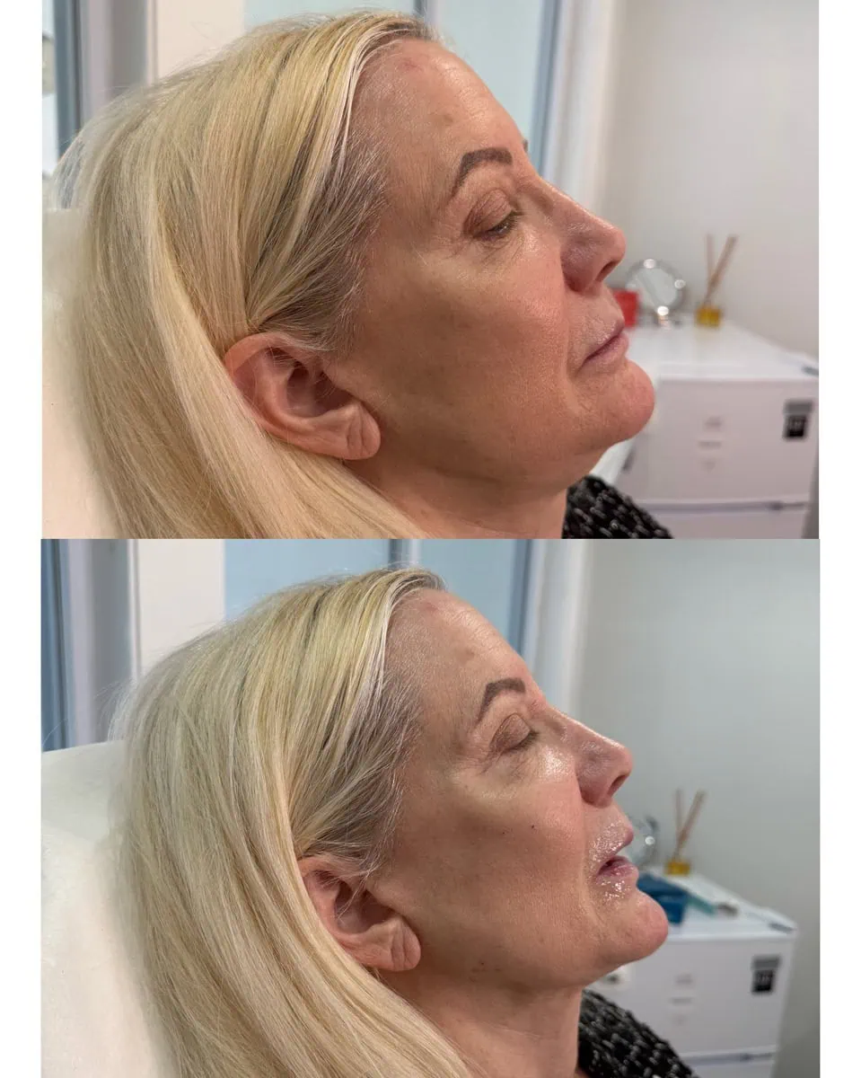 Facial Fillers before and after results