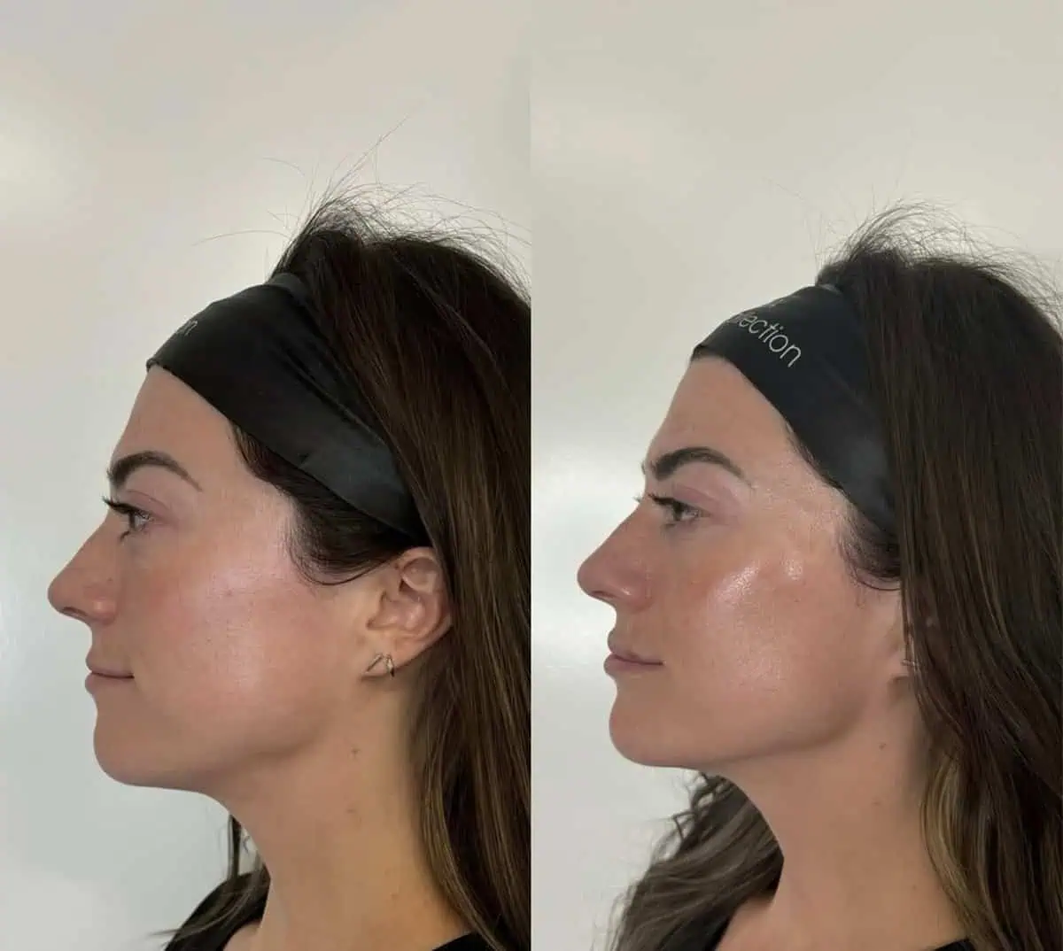 Facial Fillers before and after results