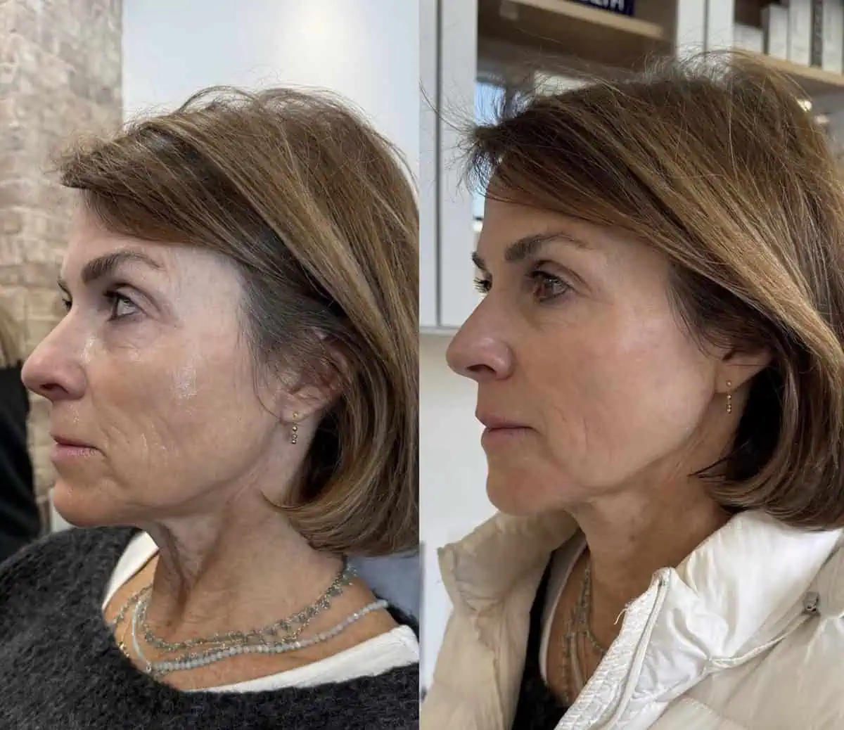 Sculptra before and after results