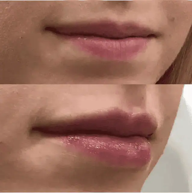 Facial Fillers before and after results