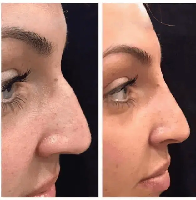 Facial Fillers before and after results