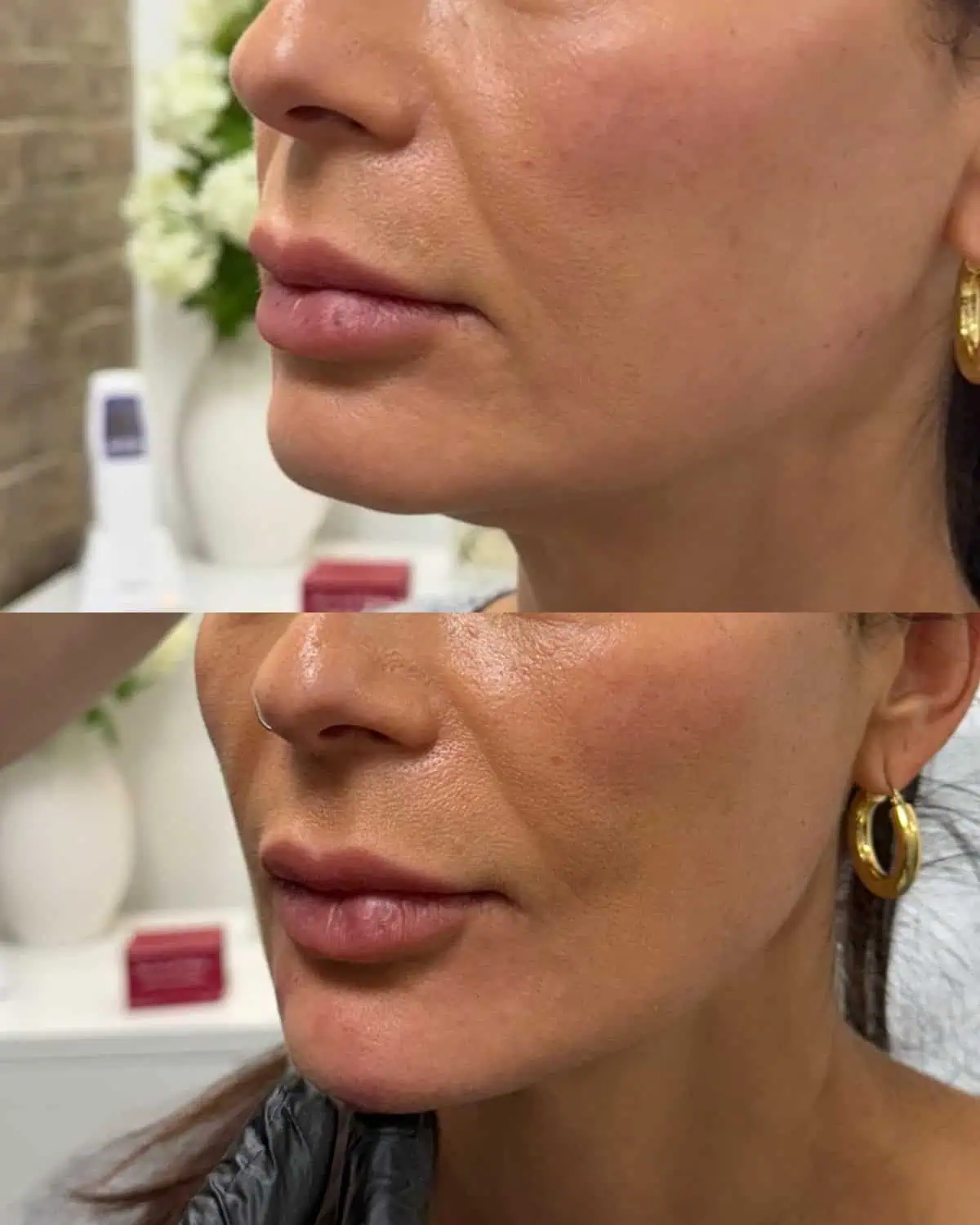 Facial Fillers before and after results
