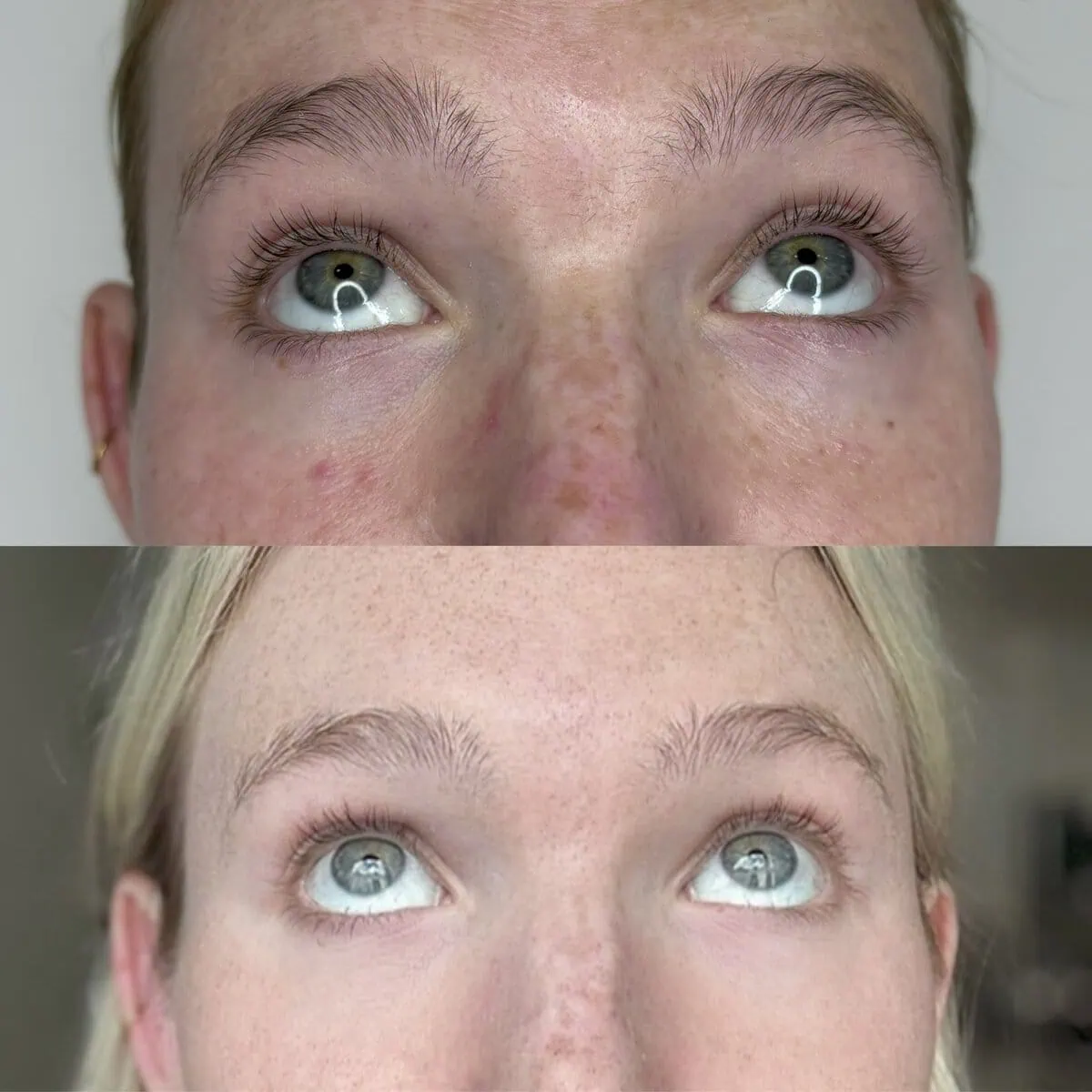 Botox before and after results