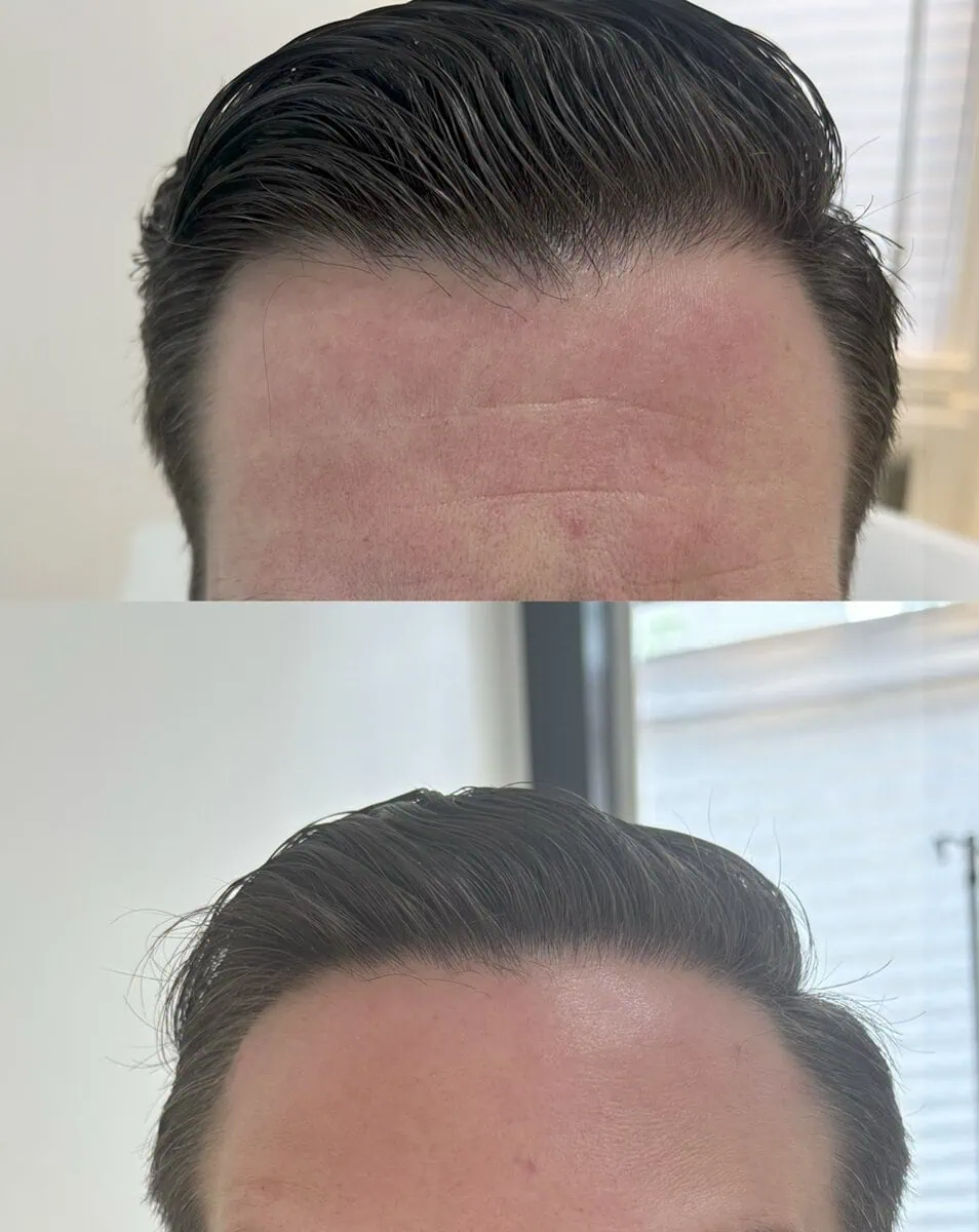 Botox before and after results