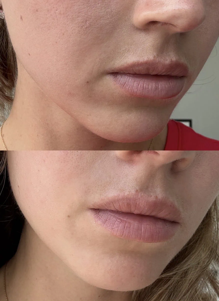 Facial Treatments before and after results