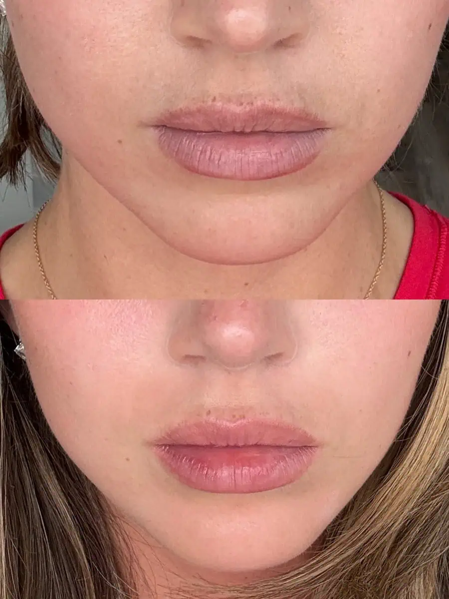 Facial Treatments before and after results