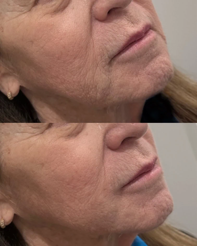 Facial Treatments before and after results