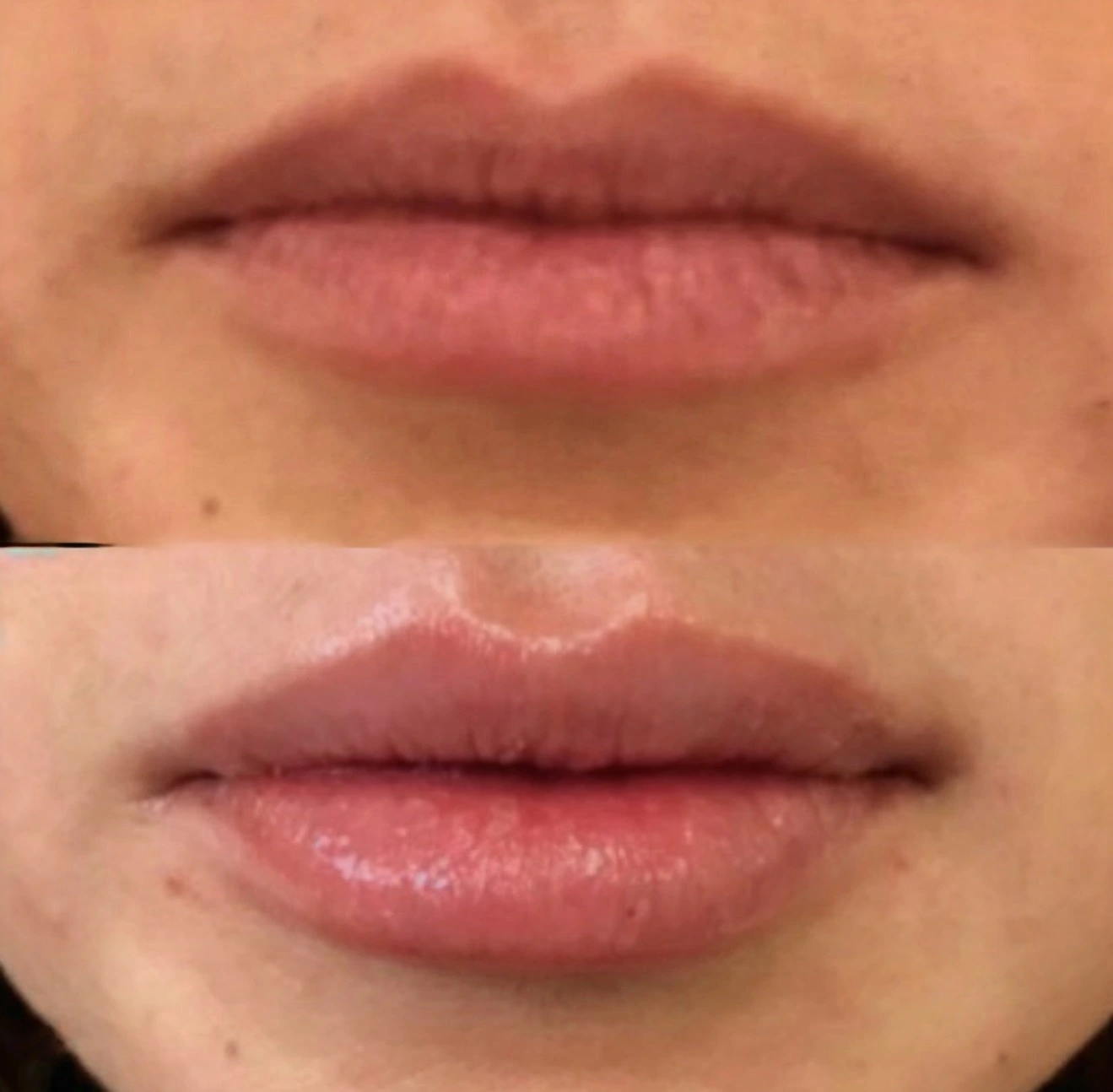 Facial Fillers before and after results