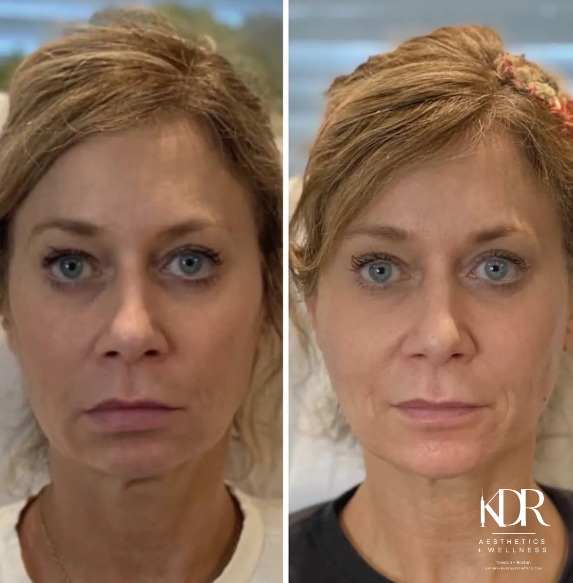 Facial Fillers before and after results
